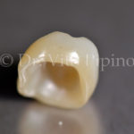 corona dentale senza metallo