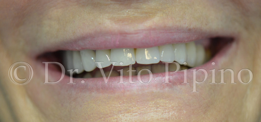 riabilitazione corone dentali senza metallo